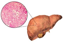 Fattly Liver Disease illustration