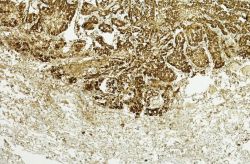 Pleural Mesothelioma Calretinin Staining illustration