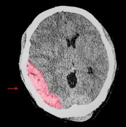 Traumatic Brain Injury or TBI illustration