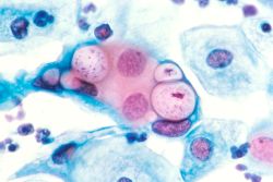 Chlamydia in pap smear